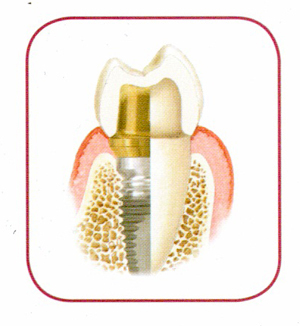 implants2 (2)